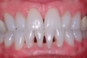 A Close-up of a tooth before a Bonding and Black Triangle Repair treatment.