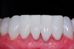 A Close-up of a tooth after a Bonding and Black Triangle Repair treatment.