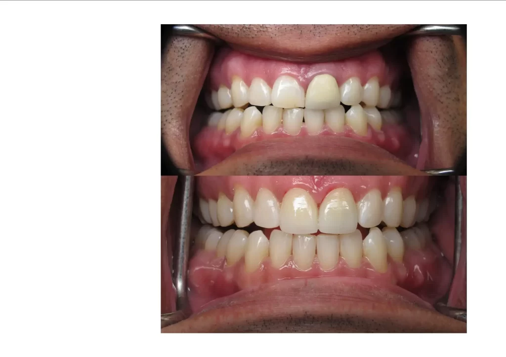 A close-up of a front tooth before and after the restoration process. The top image was taken before the restoration process, and the bottom image was taken after the restoration process.