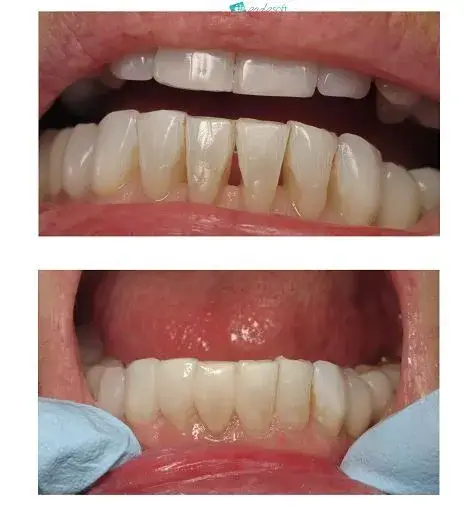 A Close-up of the before and after of a black triangle restoration The top image was taken before the procedure, and the image below was taken after the procedure.