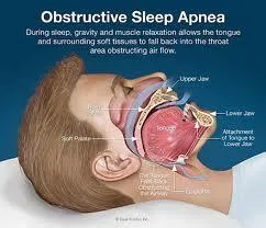 dda-obstructive-sleep-apnea